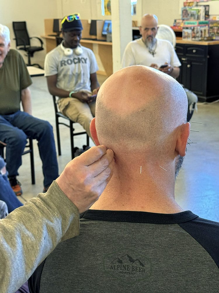 a man gets acupuncture treatment