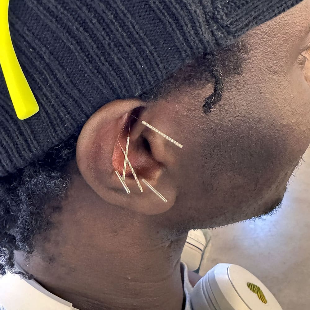a man has 5 acupuncture needles in his ear